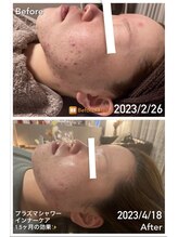 ミーアップ(Me up)/繰り返す重度ニキビケアに