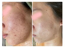 ストーリー(STORY)/ハーブピーリング専門店STORY