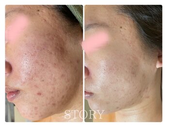 ストーリー(STORY)/ハーブピーリング専門店STORY