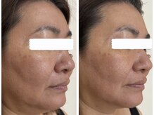 ココリル(cocorire)/沖縄初導入ULDM