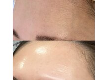 オーシャンブルーム 目黒(OceanBloom)/ハーブピーリング