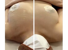 最大2～3cupアップ！産後のバストの悩み、下垂、大きさ、左右差