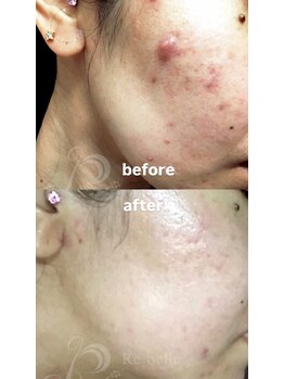 セレネ(SELENE)/ニキビ肌、頬ニキビ、赤ニキビ