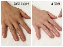 キレイテ 福岡天神店/50代/4回目【博多ハンドケア】