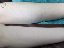 ヴィオール 名古屋栄店(VIOR)/【レデイース脱毛】　ひじ下