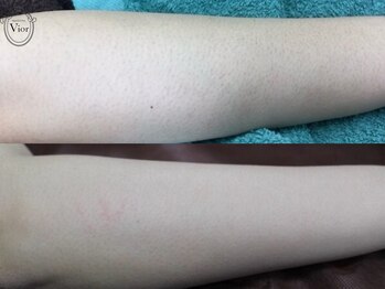 ヴィオール 名古屋栄店(VIOR)/【レデイース脱毛】 ひじ下