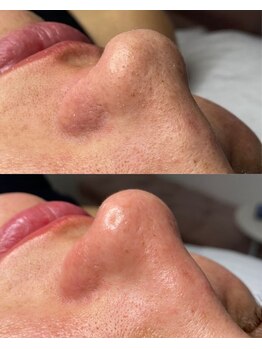 メンズエフディ ファウンデーション(メンズFD)/毛穴×サーマルフラクショナル