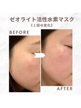 サロンソワ(salon Soi.)/ピュールボーテ：水素マスク