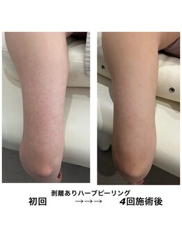 ライフ美容整体院 恵比寿(Life美容整体院)/二の腕ハーブピーリング