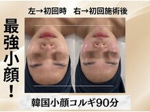 イヨヨ(iyoyo)/【小顔コルギ90分】Before After
