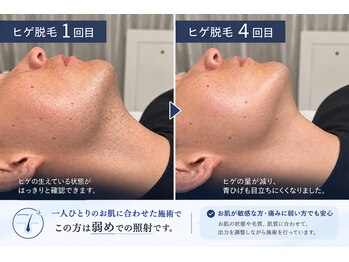 リラクゼーション幸(relaxation幸)の写真/一人ひとりにあった照射施術で脱毛デビュー!青髭卒業で朝の支度を時短しよう♪