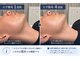 リラクゼーション幸(relaxation幸)の写真/一人ひとりにあった照射施術で脱毛デビュー!青髭卒業で朝の支度を時短しよう♪