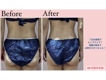 じぶんdeエステ 梅田店/CELLZERO.式 症例/お尻/1回