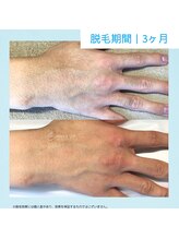 メンズクリア 高知帯屋町店/【メンズクリア】お客様の施術例