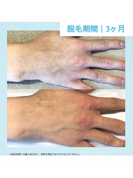 メンズクリア 高知帯屋町店/【メンズクリア】お客様の施術例
