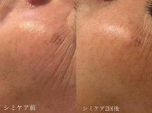 シェア(share.)/シミケア◎美白/シミ/くすみ