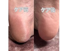 足裏角質ケアで硬くなったかかとを柔らかなふわふわかかとに♪