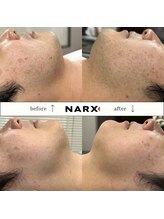 ナークス(NARX)/【ヒゲ脱毛】ビフォーアフター