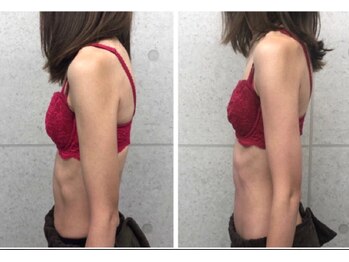 美人バスト 本厚木店/バストアップ◇症例◇