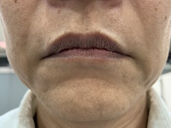 エターナル/ひげ脱毛