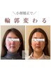 〈リフトUPにはこちら！〉たるみ改善！光フェイシャル×小顔矯正16500円→