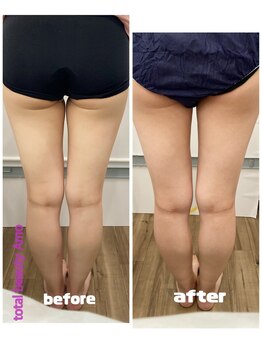 アモ(amo)/脂肪冷却ビフォーアフター