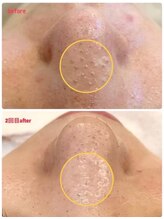 ミレボ(Me.rebo)/毛穴洗浄before→after