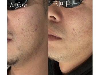 リツイート(ReTweet)/メンズ脱毛　髭　美肌ケア