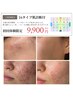 【何をしても変わらない方へ】原因分析＋肌質改善オーダーメイド施術/120分