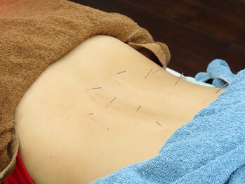 吉祥寺みやま鍼灸院/鍼施術風景