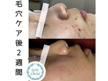 ジューンブライド(June Bride 61)/毛穴ケア