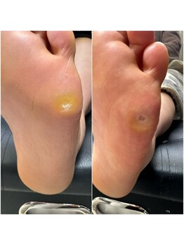 クク(KUKU)/タコ、魚の目ケアメニュー