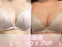 ヒヨコ 池袋西口店(Hiyoko)/バストアップ症例/育乳