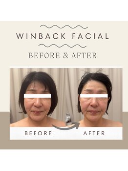 さかうえ接骨院/【BF/AF】WINBACKフェイシャル