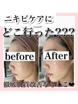 ホワイトアクア 新宿本店(WHITE AQUA)/ハーブピーリング/東京/新宿