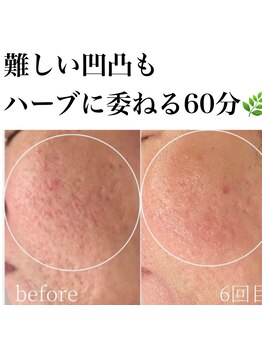 サロンツキ(salon tuki)/ハーブピーリング症例