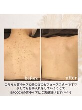 ブローチ 刈谷店(BROOCH)/背中のくすみ毛穴効果抜群です！