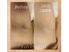  【女性限定】チラッと見える脇も自信あり/毛穴レスの脇脱毛/2,200円♪