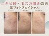 【5名様限定】 肌のボツボツ跡・毛穴の開き改善 光フォト 戸田/美肌