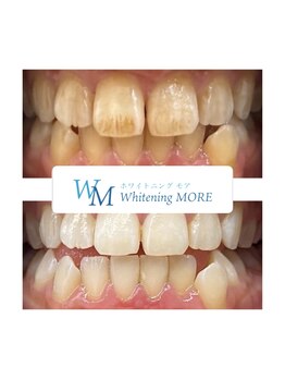 ホワイトニング モア(Whitening MORE)/ビフォーアフター