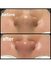 クリアボックス(Clear box)/【本気の毛穴洗浄】