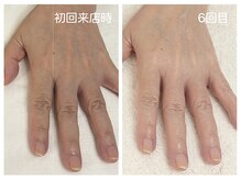 キレイテ 上野店/50代/6回目【ハンドケア上野】