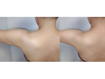 ソフィーム/冷却　腕　初回ビフォーアフター