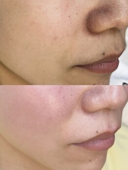 エリス(ELISSE)の写真/当店はフェイシャルワックスと光脱毛のW脱毛可能！シェービングでは叶わない肌触りツルツルな仕上がりに♪