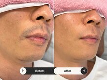 パッソ(Passo)/結婚式までにヒゲなくしましょう