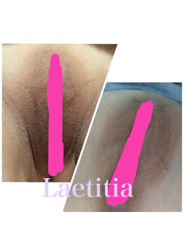 レティティア(Laetitia)/症例8【Iラインローマピンク】