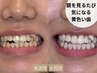 【残り3名】自信を持って笑いたい方へ|最短3回で白さを感じるホワイトニング