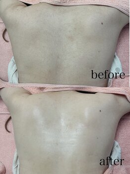 ソルシエール/うなじ×お背中剃り