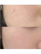 プラチナスタイル(platinum.style)/水素水毛穴洗浄 before after