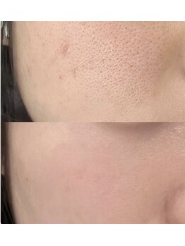 プラチナスタイル(platinum.style)/水素水毛穴洗浄 before after